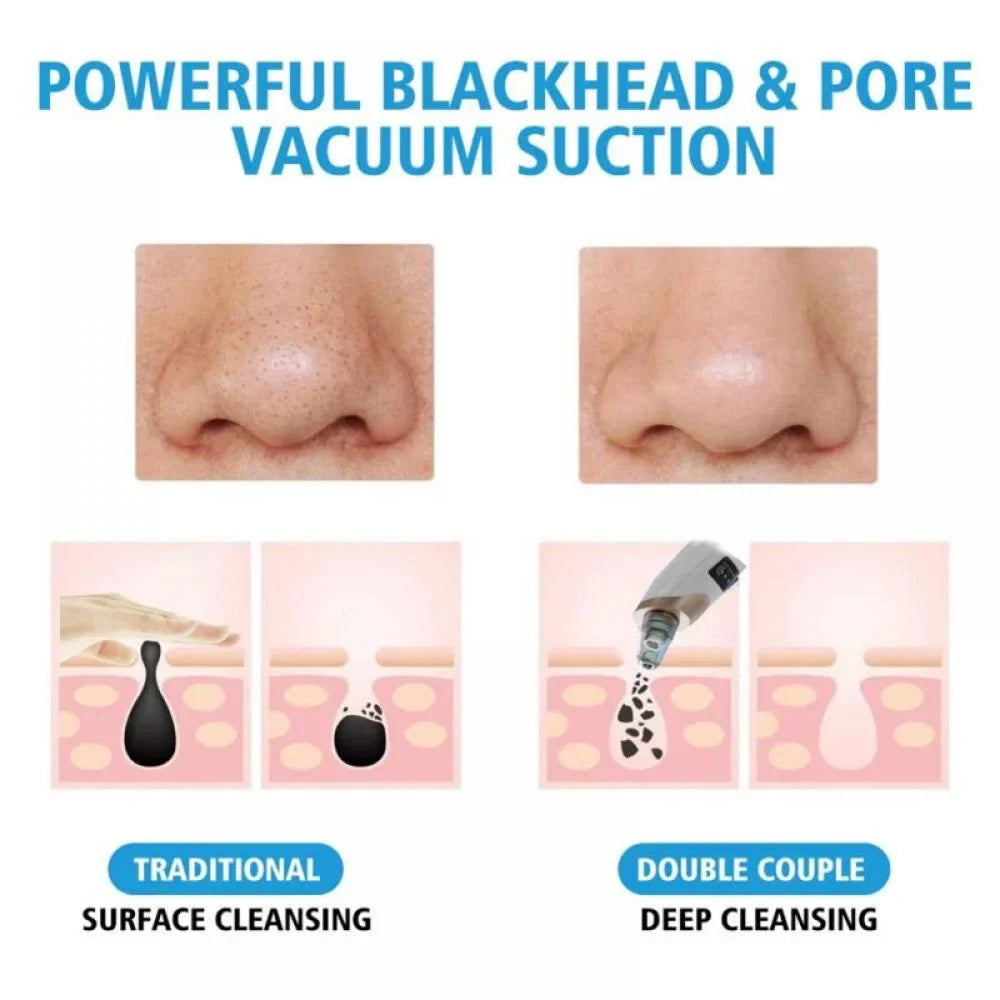 lusailstore - Electric Blackhead Remover