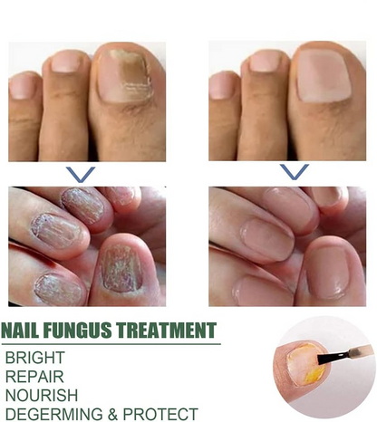 lusailstore - Nail Fungus Repair Serum