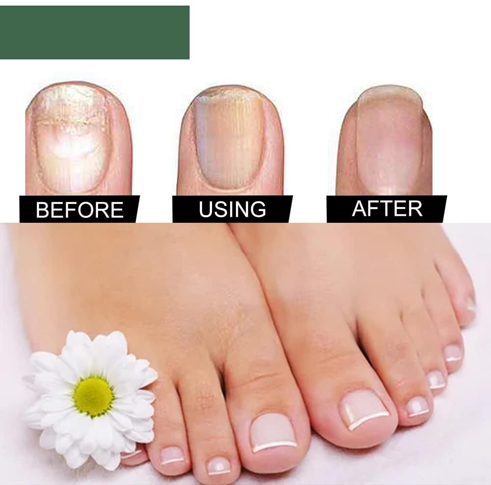 lusailstore - Nail Fungus Repair Serum